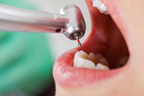 Best Knocked-Out Tooth (Avulsed Tooth) Treatment in Shadybrook, TX
